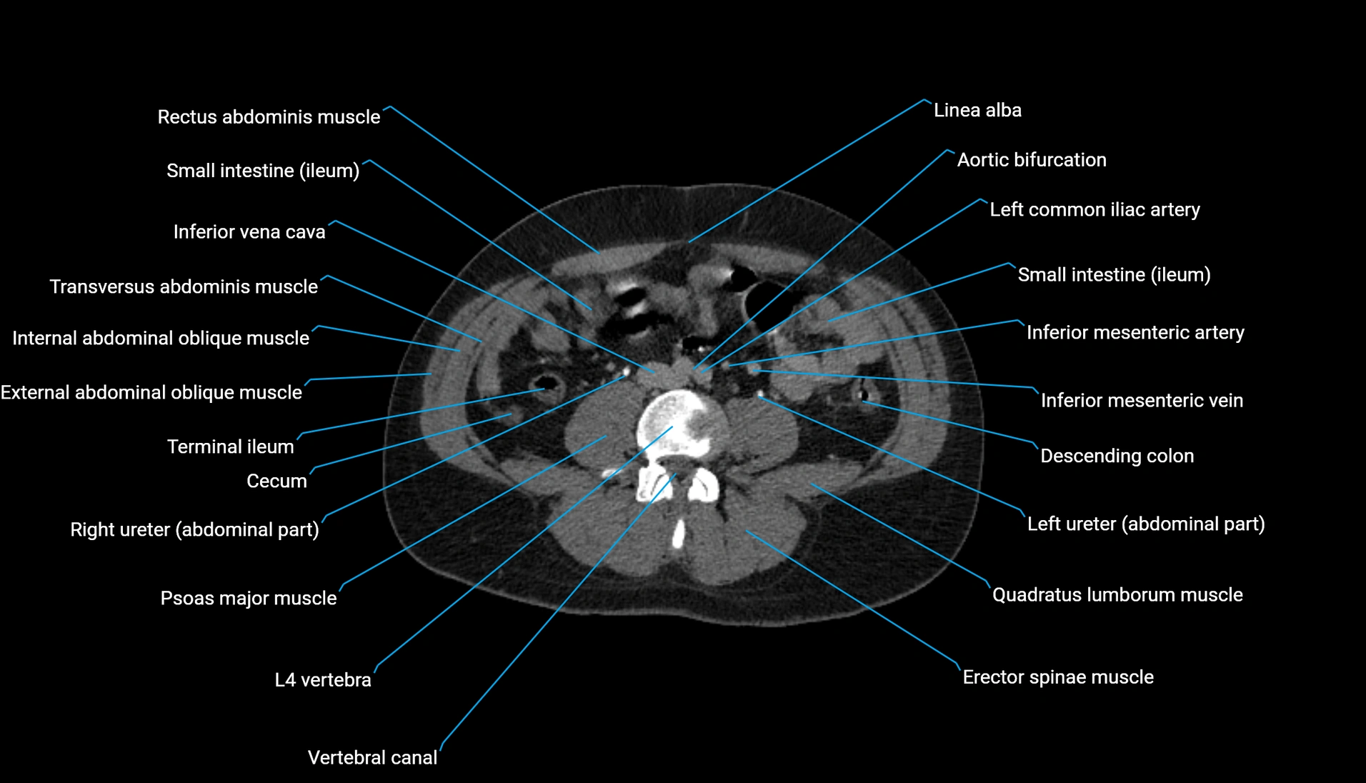 CT urogram axial cross sectional anatomy  labelled radiology image-00146.webp